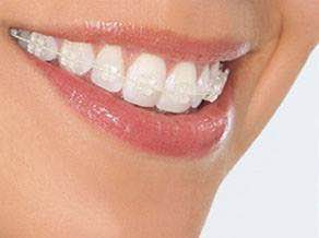 Clear Braces vs. Metal Braces, Frazer Dental Care