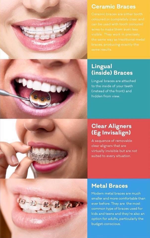 Clear Braces vs. Metal Braces, Frazer Dental Care