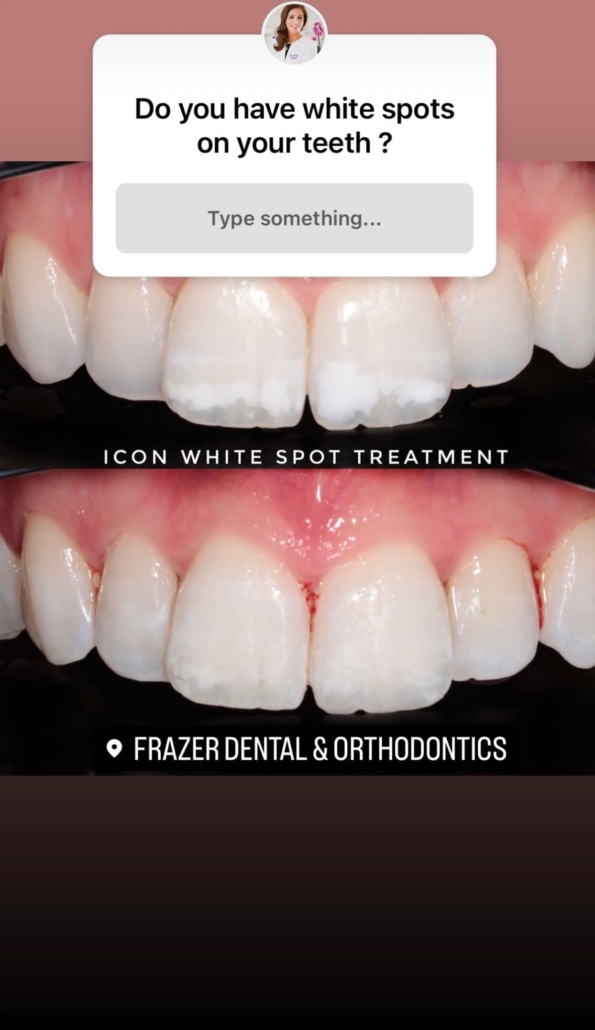 How To Get Rid of White Spots on Teeth